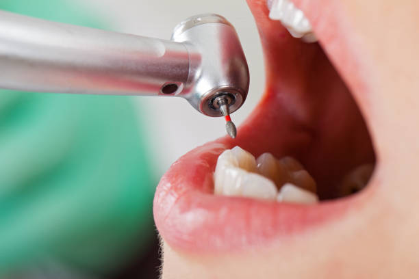 Best Emergency Wisdom Teeth Removal in Avimor, ID
